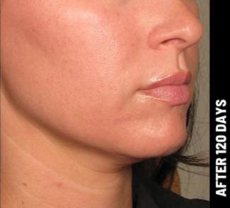 Ultherapy Before & After Patient #1552
